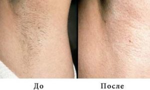 Using the Photoepilator