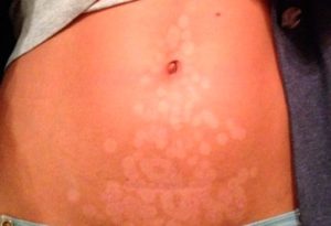 Disadvantages of using a photoepilator