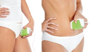 Photoepilation procedure