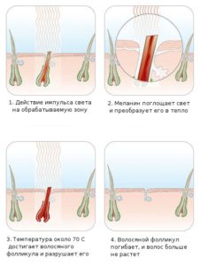 Benefits of photoepilation.