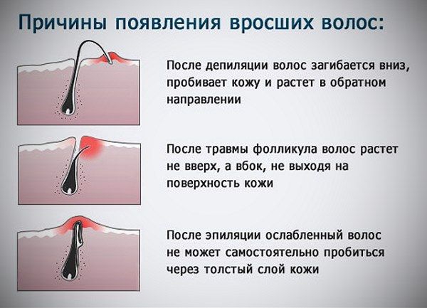 Prevention of ingrown hairs from hair removal